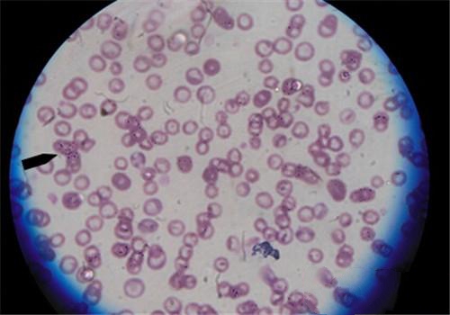血涂片可见的巴贝斯虫，是其中一种虫媒病，侵蚀红细胞