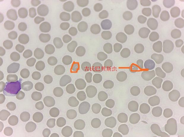 血涂片可见带有虫体的红细胞