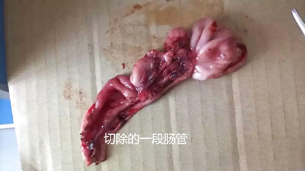 切除的一段肠管