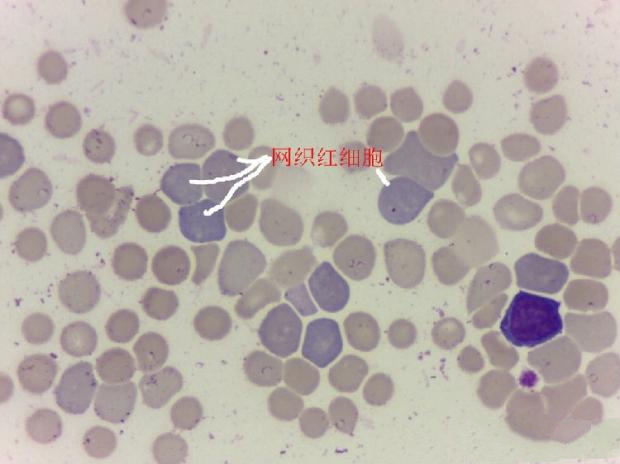 血涂片中可见大量的网织红细胞