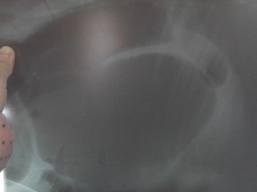 X光检查，显示胃部增大，气体充满整个胃部（左侧位）。黑色阴影部分。