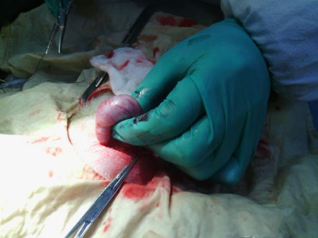 图为从腹股沟处分离出隐睾，隐睾还在鞘膜中未被分离出