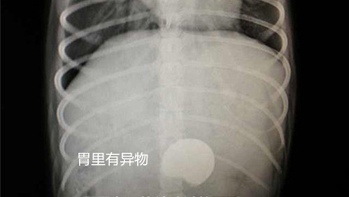 X光片可见胃内异物
